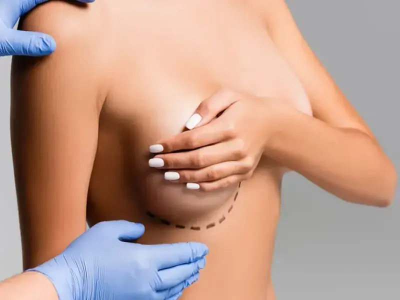 Mastopexia sau ridicarea sânilor – Cum să te bucuri din nou de tinerețe
