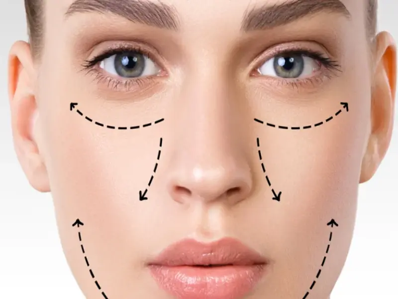 Liftingul facial cu fire resorbabile